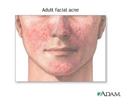 Adult Acne Cure