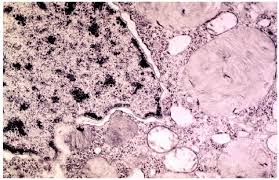 In Tay-Sachs disease, 