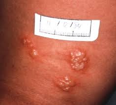 Foto di herpes - ca