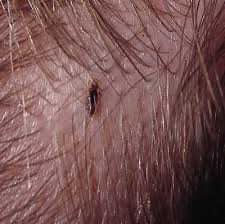 القمل Head_louse_closeup%255B1%255D