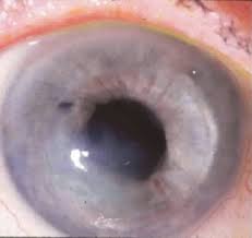 Keratitis