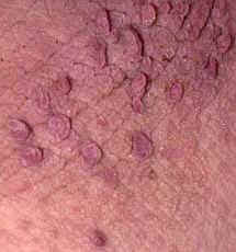 How To Remove Large Skin Tags