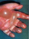 http://tbn1.google.com/images?q=tbn:h0G9R7JzNq6_2M:http://www.burnfree.de/img/verbrennung-hand.jpg