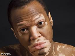 le vitiligo Art.vitiligo.thomas.ap