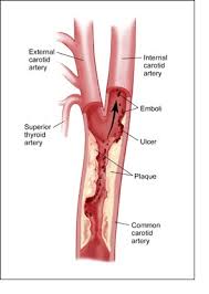 Carotid artery disease is a type of 
