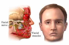 Bells palsy perawatan Bell's palsy