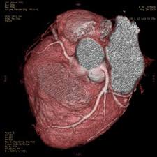 asuhan keperawatan payah jantung oedem paru